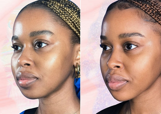 HB Team Tries: I Got Dermal Fillers In The Last Year Of My 20s & It Was My Best Purchase Yet - A1