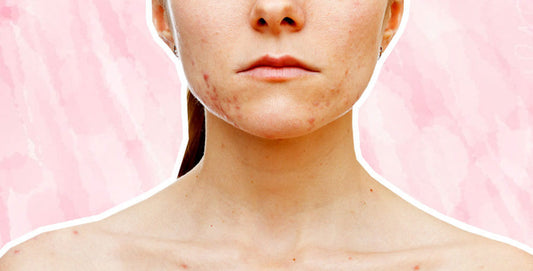 This Pill Could Finally Get Rid Of Hormonal Acne - A1