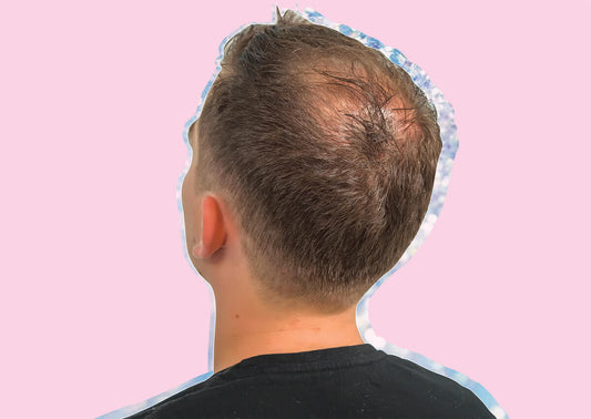 Male Pattern Baldness: Causes, Prevention & The Best Treatments - A1