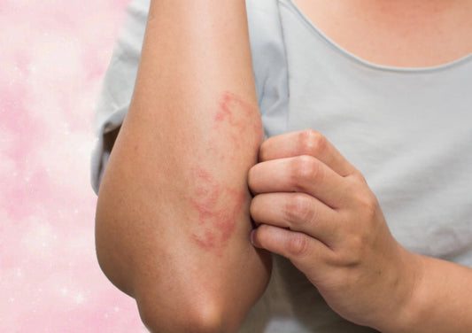 What Causes Eczema And How To Treat It Like A Derm - A1