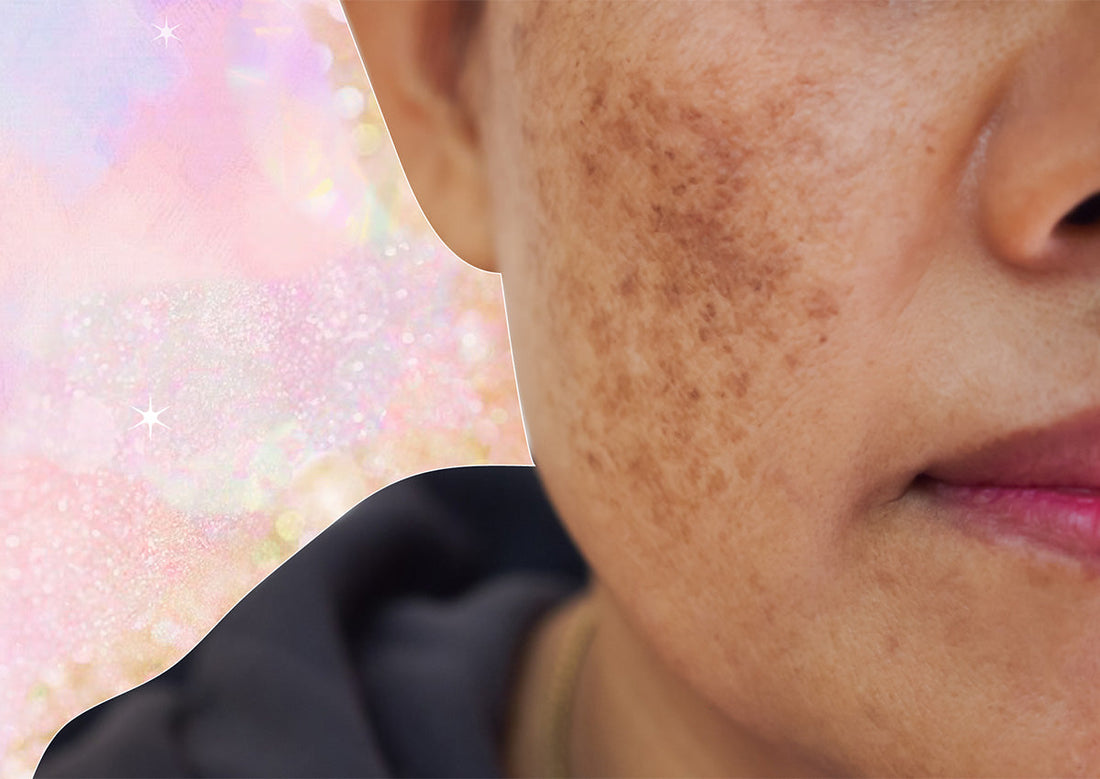 If You’ve Ever Dealt With Melasma, You Should Read This - A1