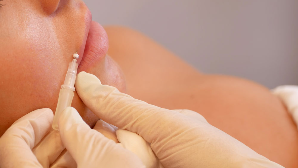 Forget Lip Fillers, Lip Threads Are WAY Better - A1