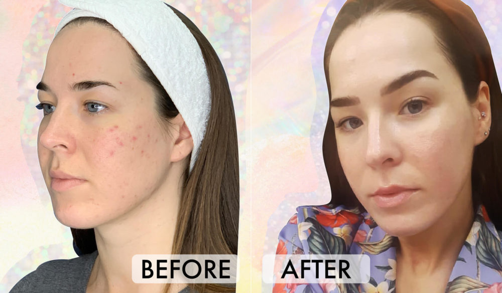 PRP (The Vampire Facial) Transformed Our Skin On Another Level - A1