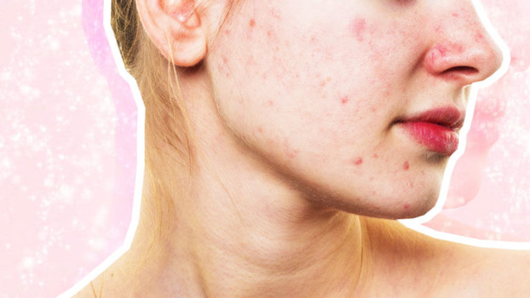 This Might Be The Reason Your Acne Won't Go Away - A1