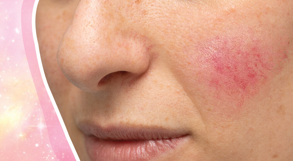Rosacea: What To Avoid & The Best Derm-Approved Treatments - A1