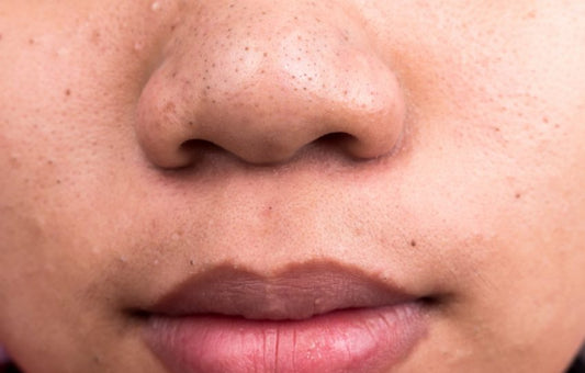 Easy Ways To Purify Your Pores Without Spending $$$ - A1