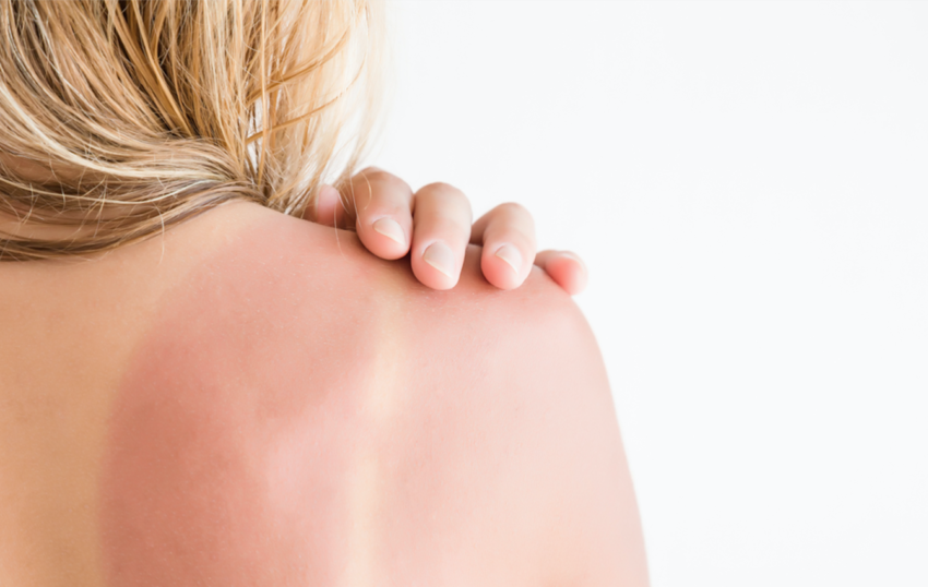 Damage Control 101: What To Do When You Get Sunburned - A1
