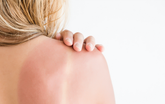 Damage Control 101: What To Do When You Get Sunburned - A1