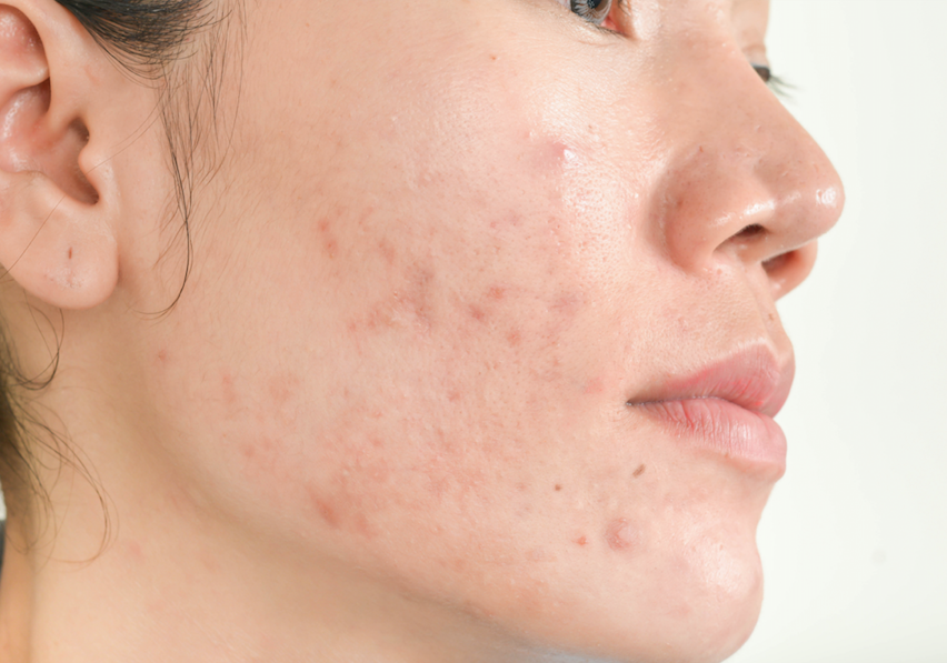 An Expert Shares 5 Things You Never Knew About Acne - A1