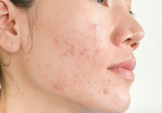 An Expert Shares 5 Things You Never Knew About Acne - A1