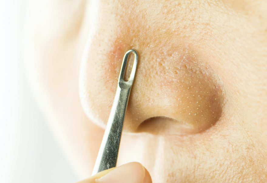 How These Acne Tools Could Be Making Your Skin Worse - A1