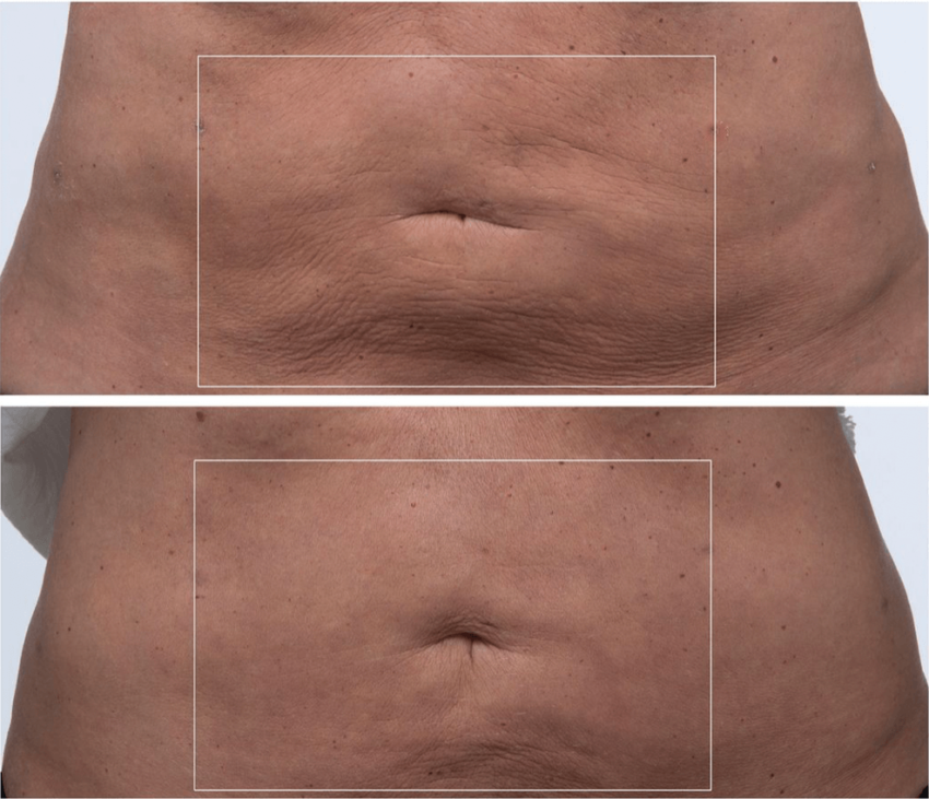 I Tried The Tool That ACTUALLY Gets Rid Of Cellulite - A1