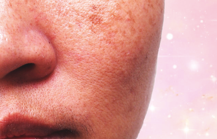 How To Treat Dark Spots Like A Derm - A1