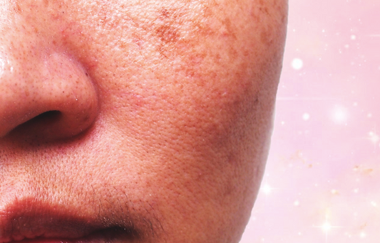 How To Treat Dark Spots Like A Derm - A1