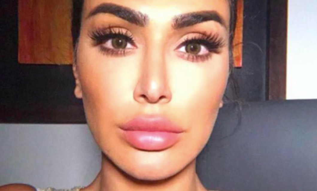 Must Read: Why Removing My Lip Filler Was The Best Thing I Ever Did - A1
