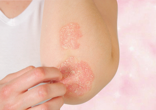 The Ultimate Guide To Psoriasis: What Causes It And How To Treat It - A1