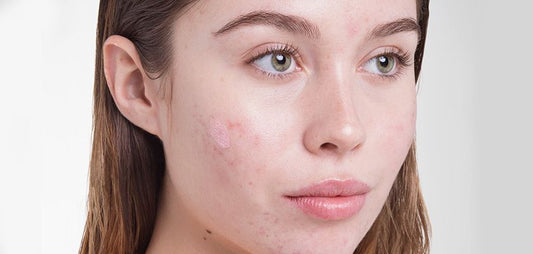 How To Treat Cystic Acne At Home - A1