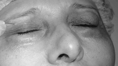 How To Remove Dark Circles Overnight: Carboxy Works! - A1