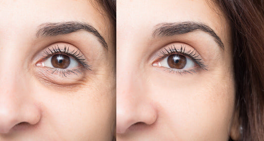 Undereye Filler And How To Tackle Undereye Hollowness - A1