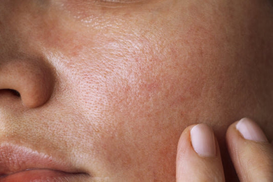 This Is Basically a Miracle Treatment for Acne Scars - A1