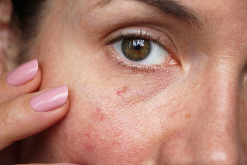 How To Prevent And Remove Spider Veins - A1