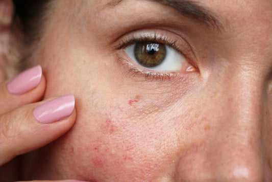 How To Prevent And Remove Spider Veins - A1