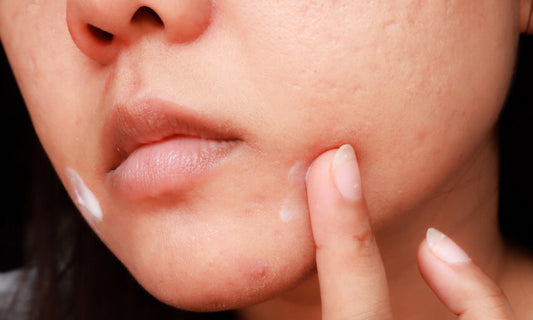 What's Up With All Those Little Whiteheads On Our Chin?! - A1