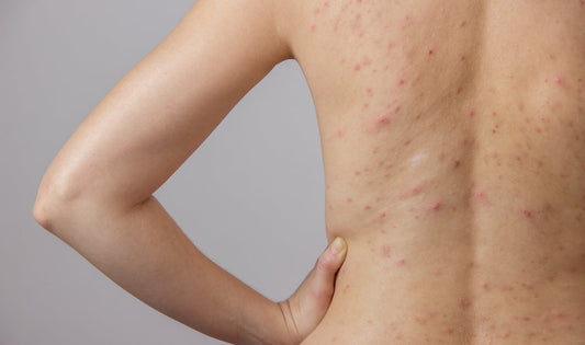If You Have Body Acne, You Need To Try This! - A1